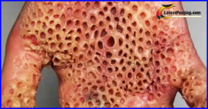worm trypophobia skin