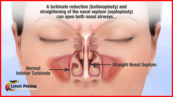 Best Septoplasty Surgeons in Dubai